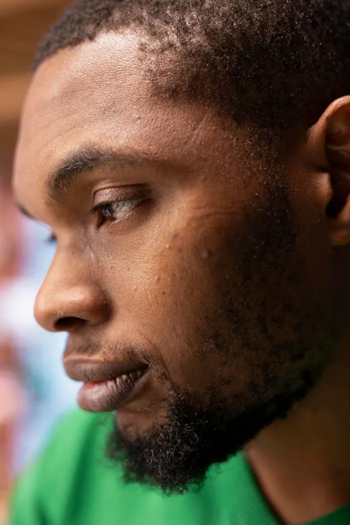 Epilation laser des pommettes sur peaux noires